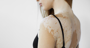 Vitiligo